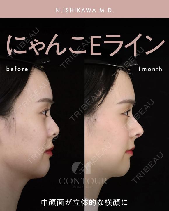 忘れ鼻整形 before画像 メイン用