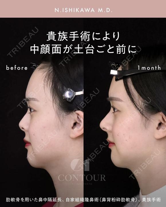 忘れ鼻整形 30日後 メイン用
