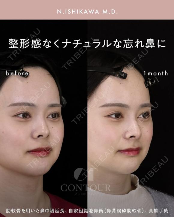 忘れ鼻整形 30日後 メイン用