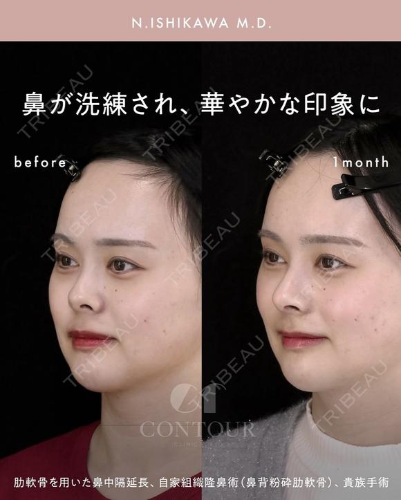 忘れ鼻整形 30日後 メイン用