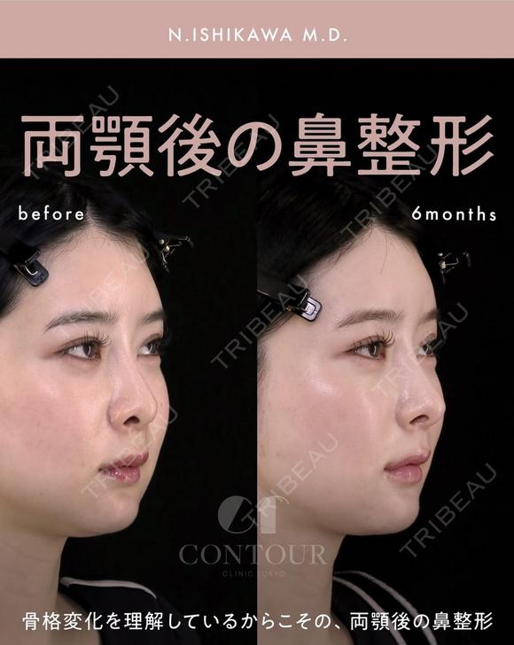 忘れ鼻整形 before画像 メイン用