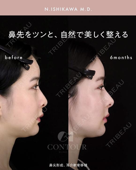 忘れ鼻整形 180日後 メイン用