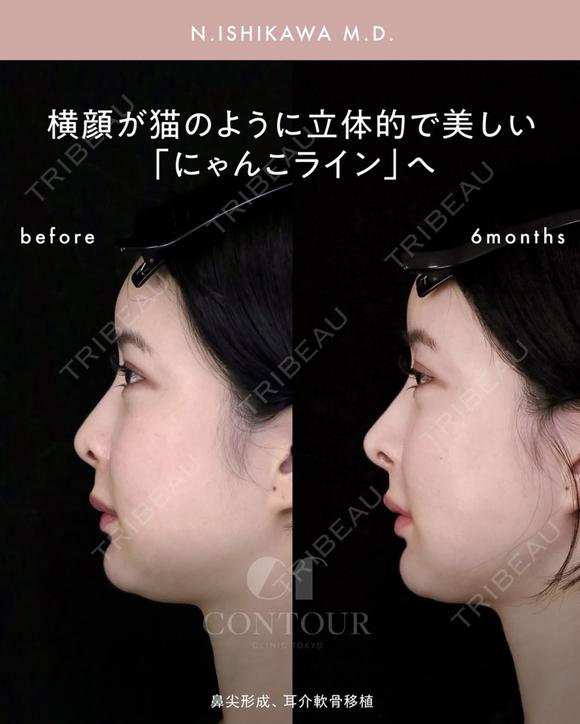 忘れ鼻整形 180日後 メイン用