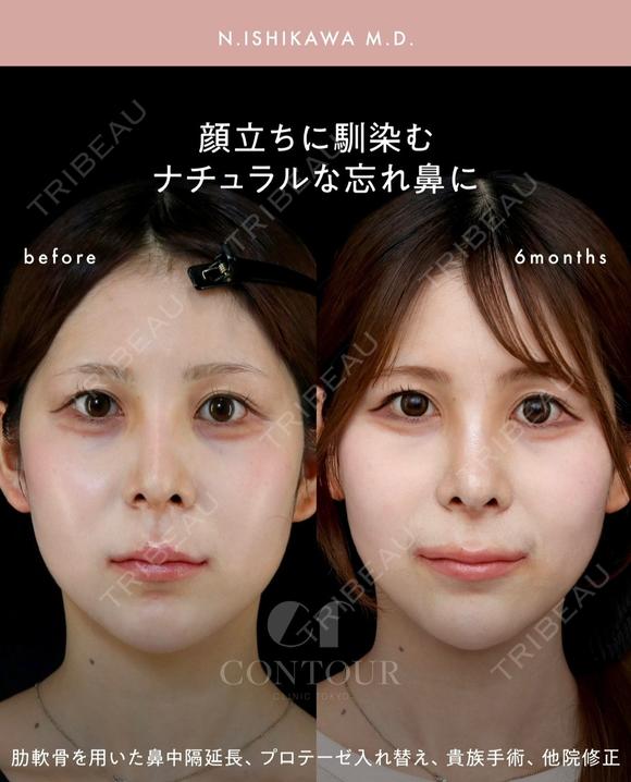 忘れ鼻整形 180日後 メイン用