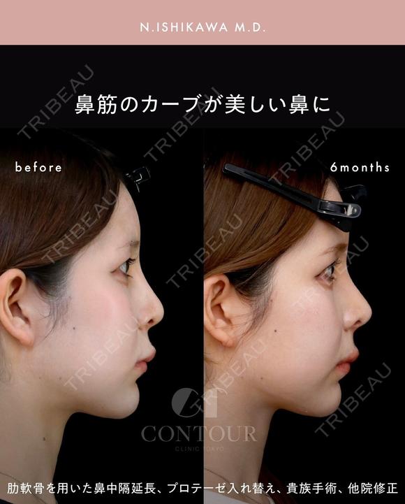 忘れ鼻整形 180日後 メイン用