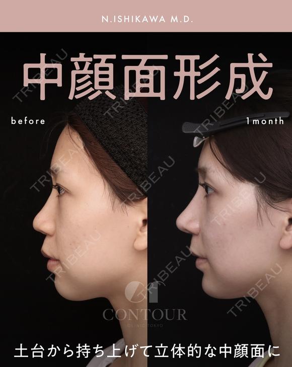 忘れ鼻整形 before画像 メイン用
