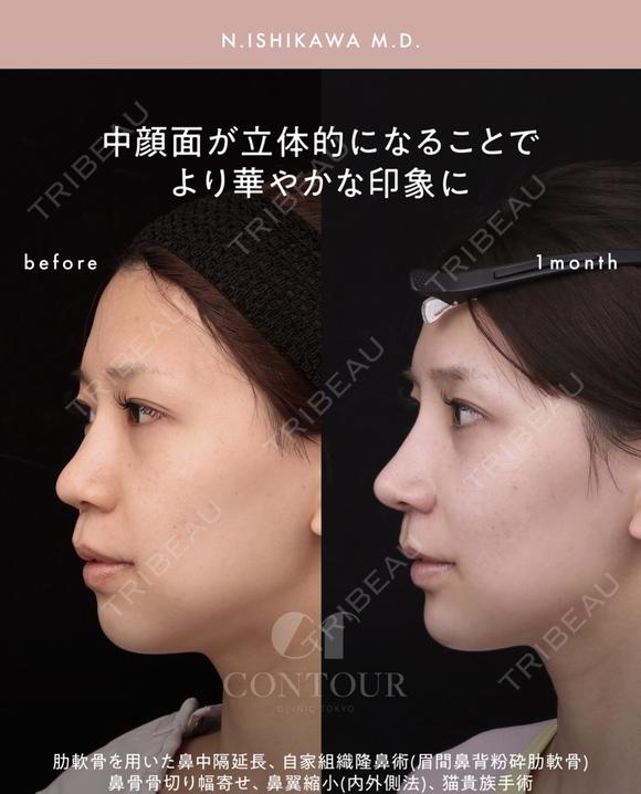 忘れ鼻整形 30日後 メイン用