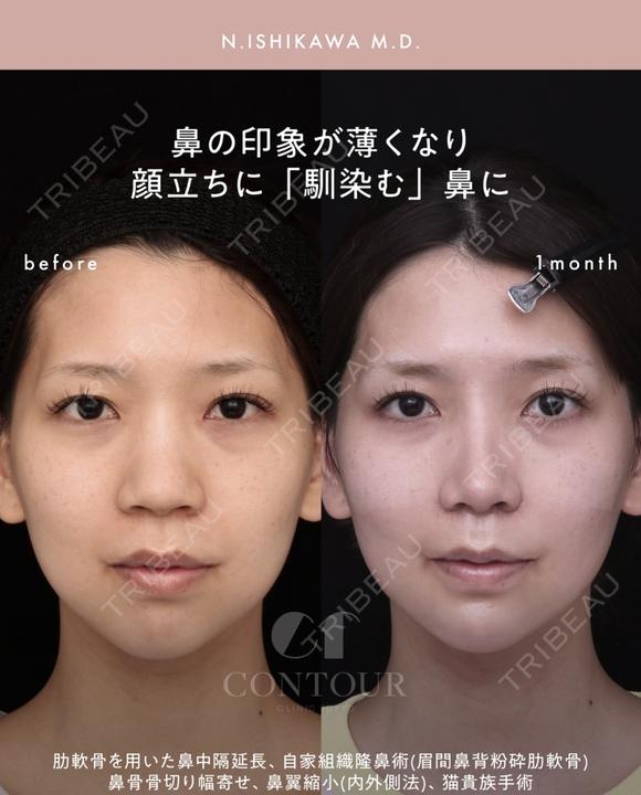 忘れ鼻整形 30日後 メイン用