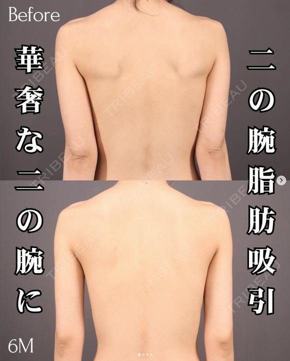 ベイザー二の腕＋肩脂肪吸引 180日後 メイン用