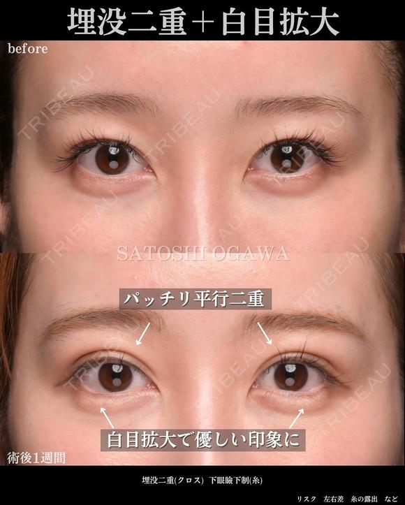 埋没クロス法＋下眼瞼下制（糸） 7日後 メイン用