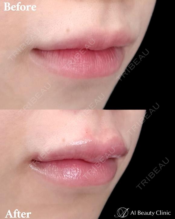 唇ヒアルロン酸 after画像 メイン用