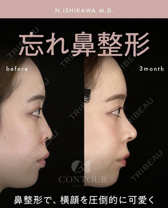 忘れ鼻整形 before画像 メイン用