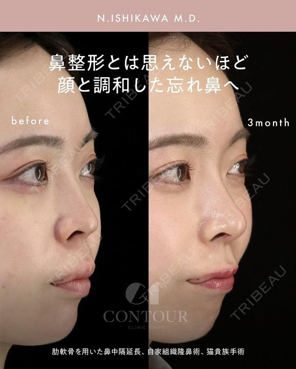 忘れ鼻整形 90日後 メイン用