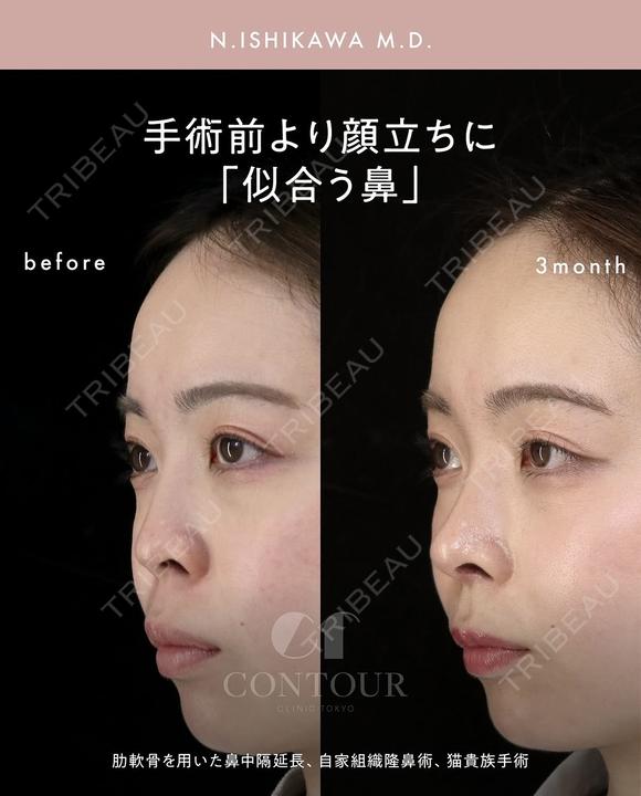 忘れ鼻整形 90日後 メイン用