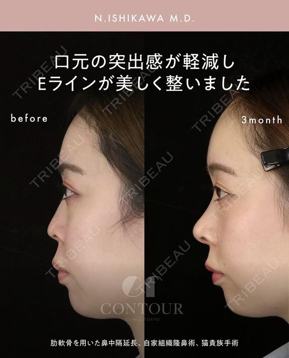 忘れ鼻整形 90日後 メイン用