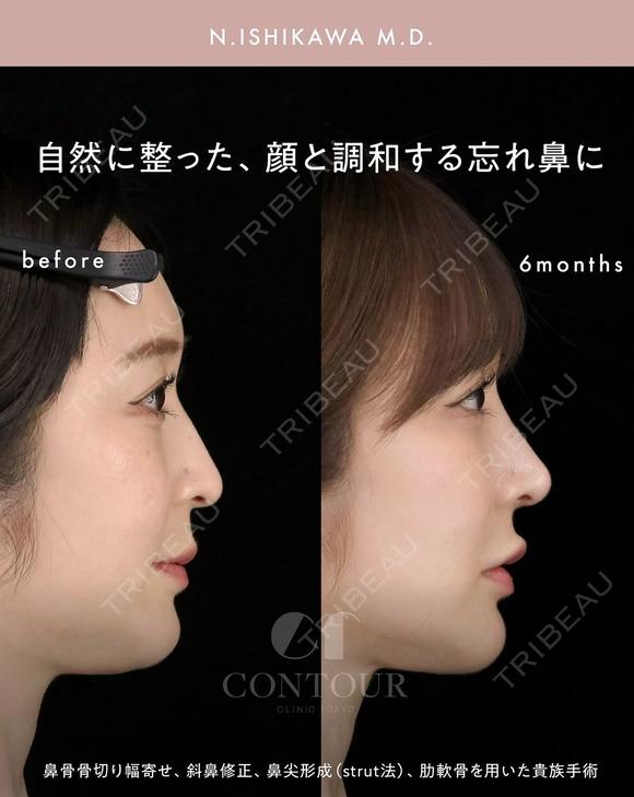 忘れ鼻整形 180日後 メイン用