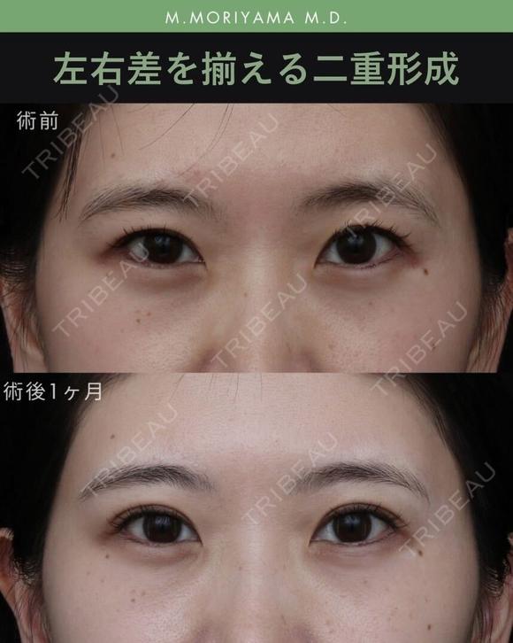 左右差を揃える二重形成 30日後 メイン用
