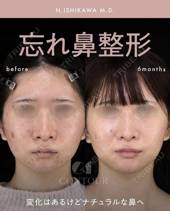 忘れ鼻整形 180日後 メイン用