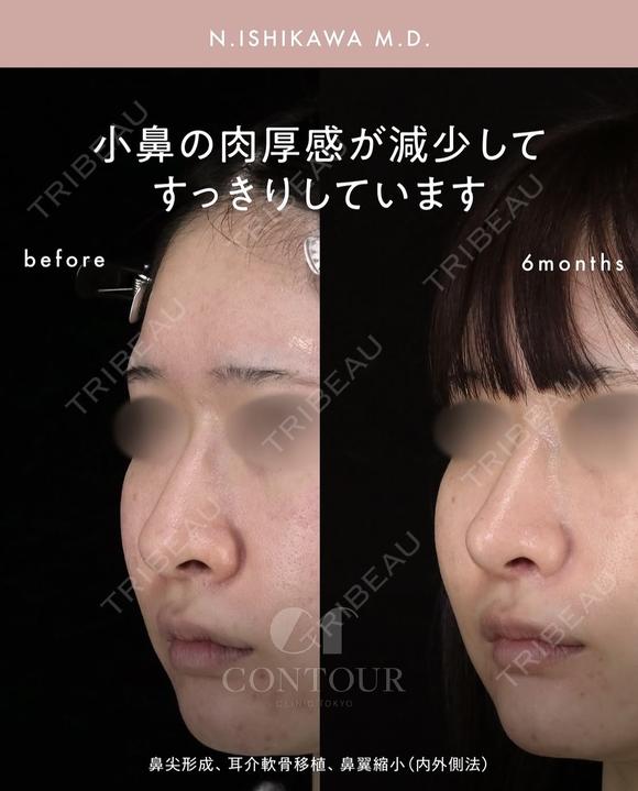 忘れ鼻整形 180日後 メイン用