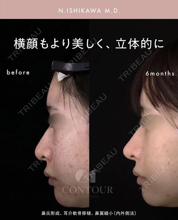 忘れ鼻整形 180日後 メイン用