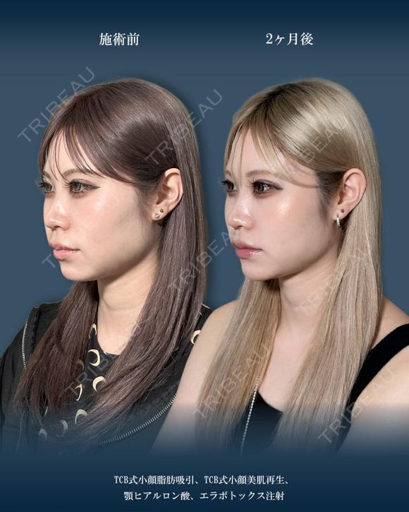 顔の脂肪吸引＋小顔美肌再生（リフトアップ）＋顎（あご）のヒアルロン酸注射＋エラのボトックス小顔注射 before画像 メイン用