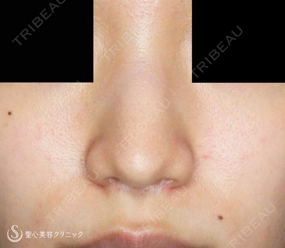 【難易度「特級」忘れ鼻をつくる】小鼻縮小術+α法「Ver.7.5」（直後〜7ヶ月後） 210日後 メイン用