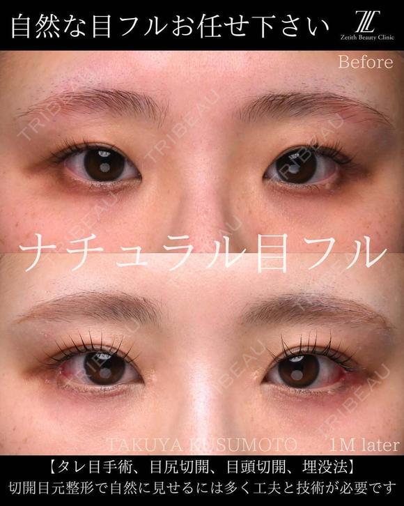 ナチュラル目フル 30日後 メイン用