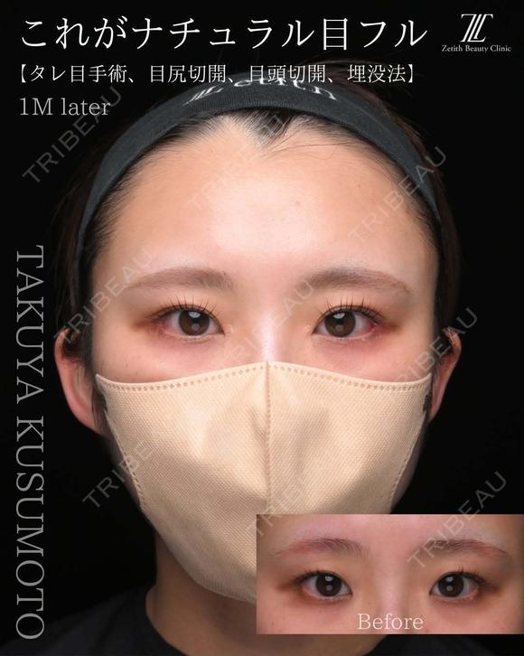 ナチュラル目フル 30日後 メイン用
