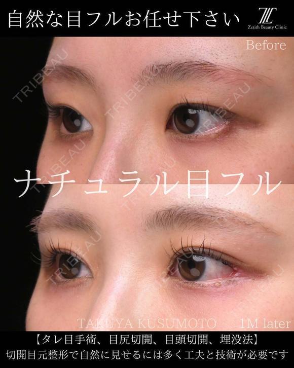 ナチュラル目フル 30日後 メイン用