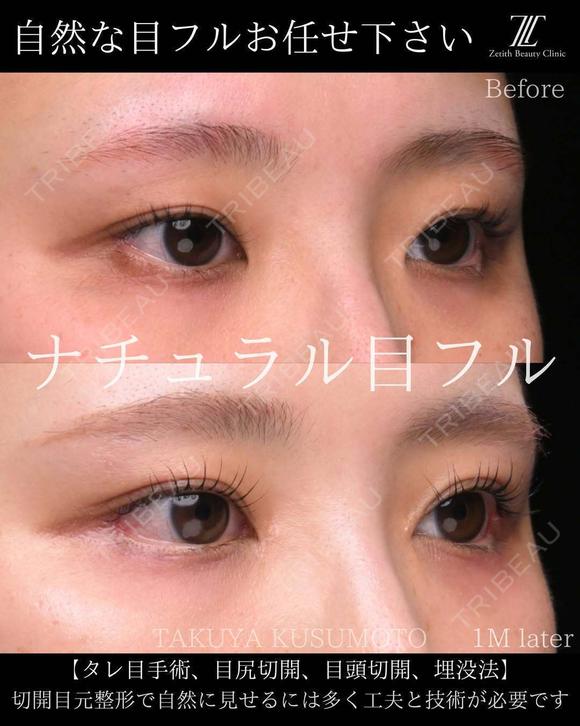 ナチュラル目フル 30日後 メイン用