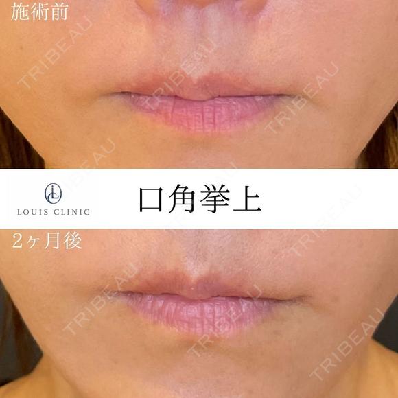 口角挙上 60日後 メイン用