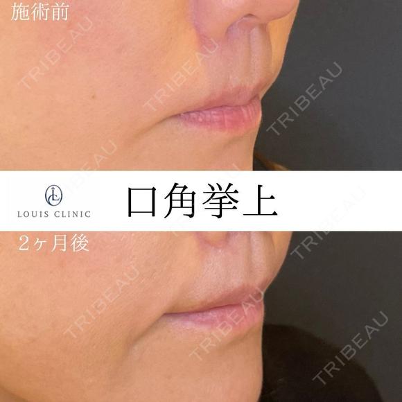 口角挙上 60日後 メイン用