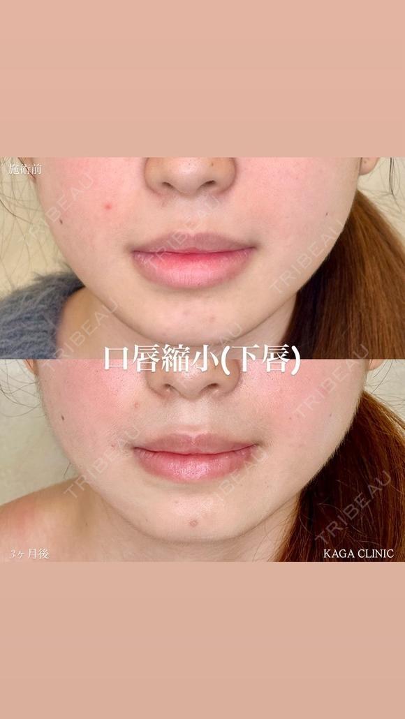 加賀デザイン×下唇口唇縮小 after画像 メイン用