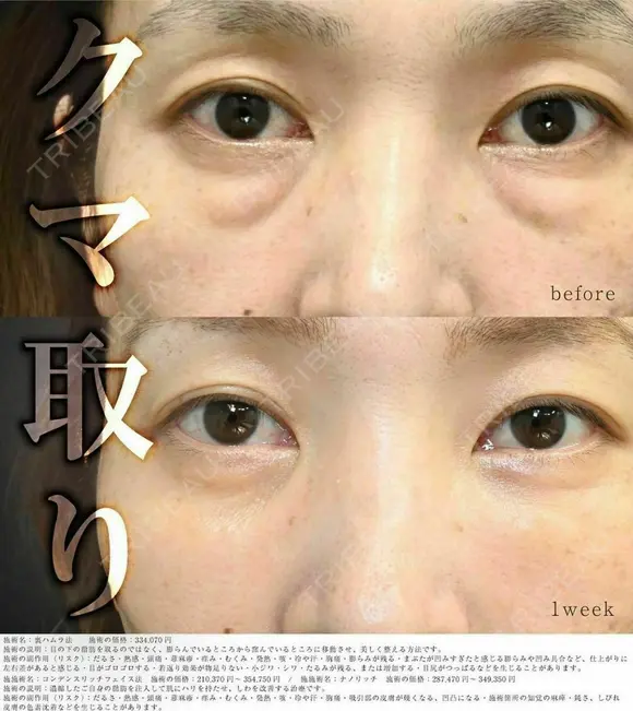 クマ取りで疲れ顔解消🧸 before画像 メイン用