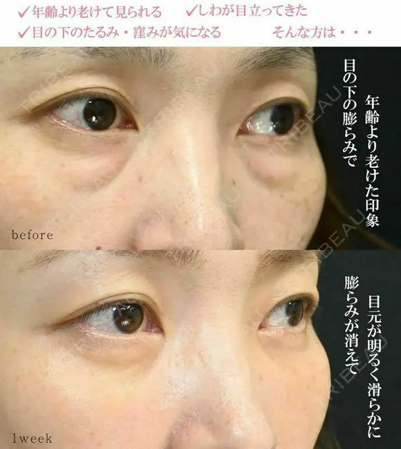 クマ取りで疲れ顔解消🧸 7日後 メイン用