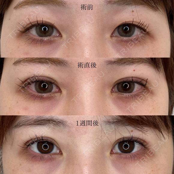 二重埋没法 before画像 メイン用