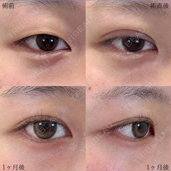 二重埋没法 before画像 メイン用