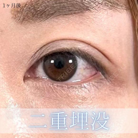 二重埋没法 30日後 メイン用
