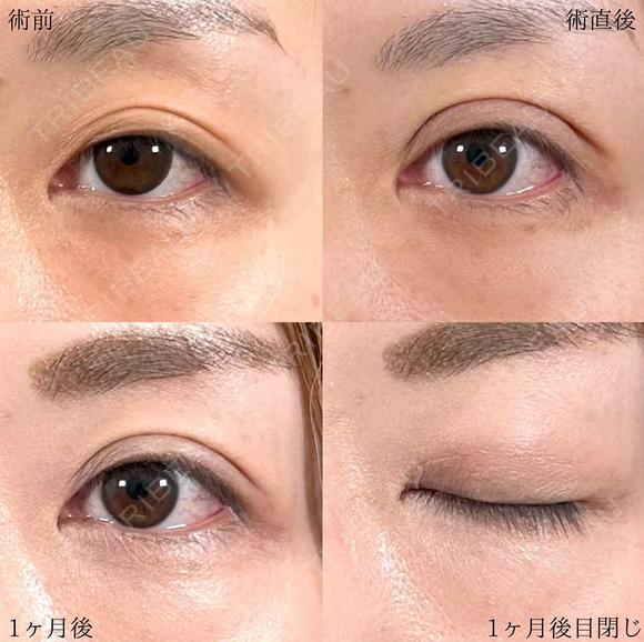 二重埋没法 before画像 メイン用