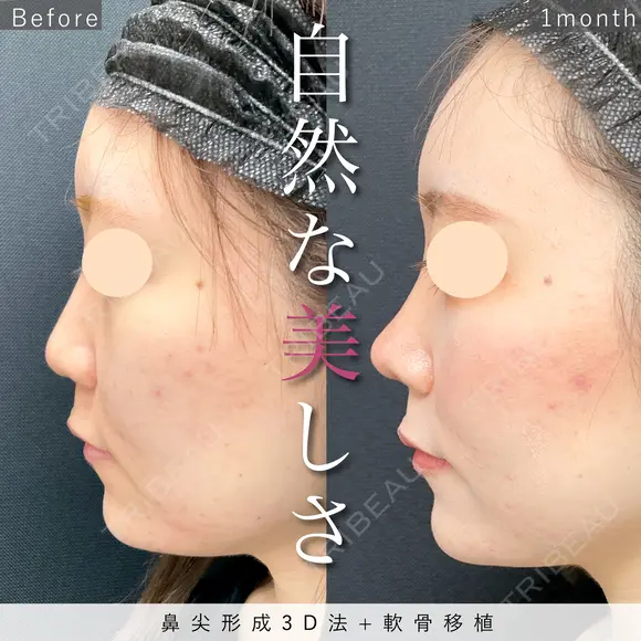 ツンとした美鼻に♡鼻尖形成3D法+軟骨移植 after画像 メイン用