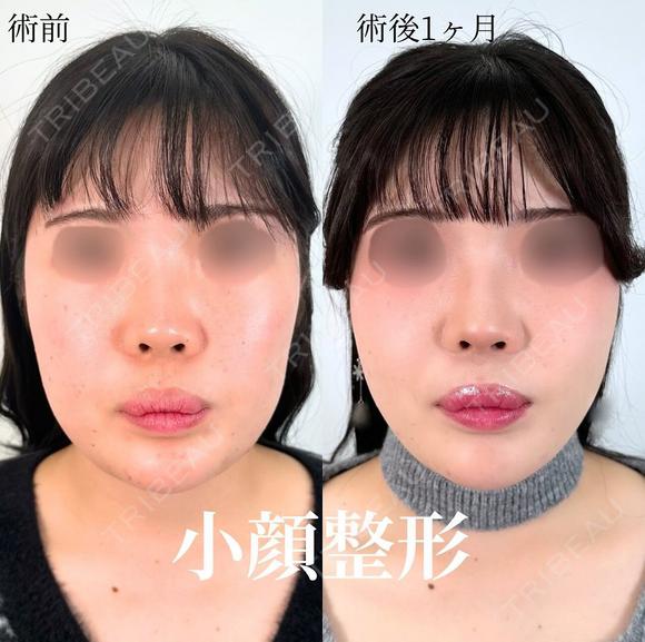 小顔美肌再生（リフトアップ）＋顔の脂肪吸引＋エラのボトックス小顔注射 30日後 メイン用