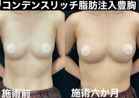 美ラインの豊胸術💕 180日後 メイン用