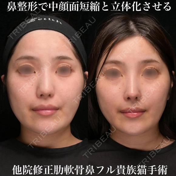 肋軟骨鼻フル before画像 メイン用