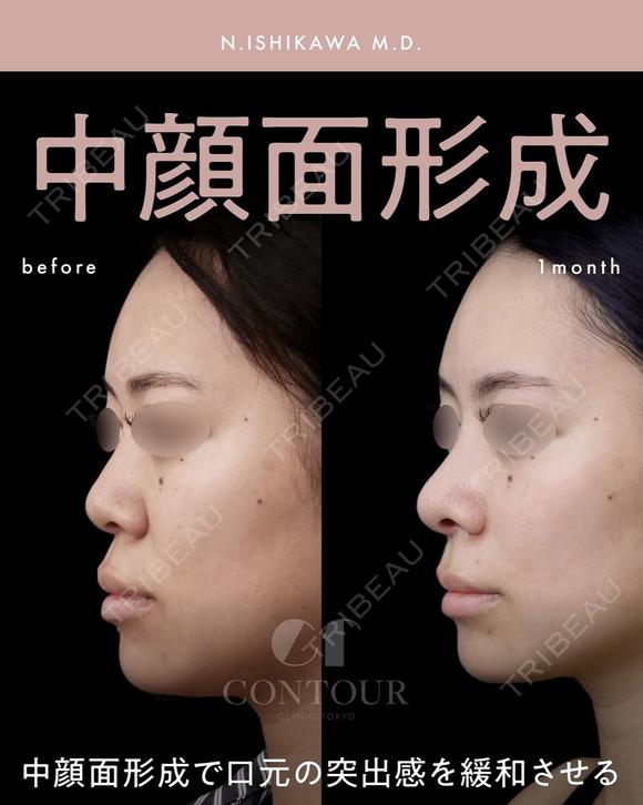 忘れ鼻整形 before画像 メイン用