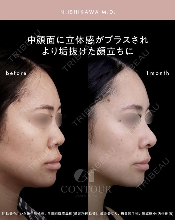 忘れ鼻整形 30日後 メイン用