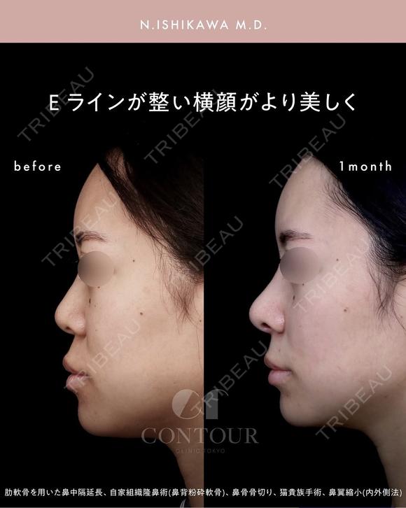 忘れ鼻整形 30日後 メイン用