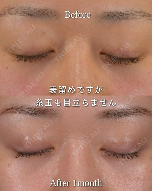 Zetith Eyes(3点留め埋没)  30日後 メイン用