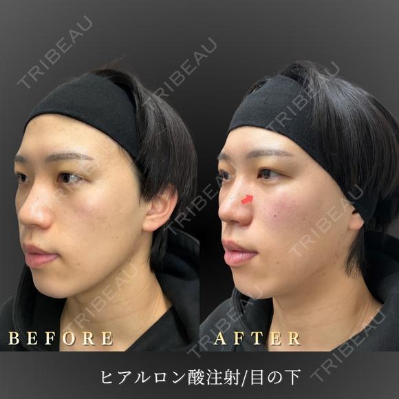 ヒアルロン酸注入術/頬コケ after画像 メイン用