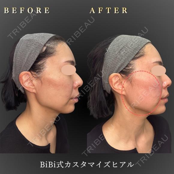 フェイスリフト/ヒアルロン酸注入 before画像 メイン用