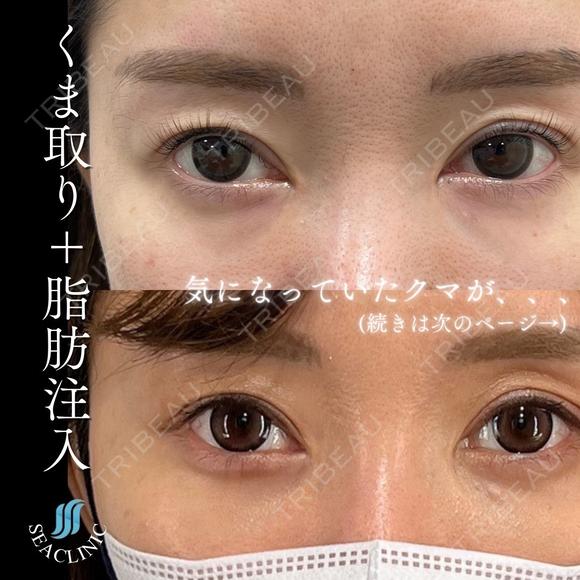くま取り＋脂肪注入 before画像 メイン用